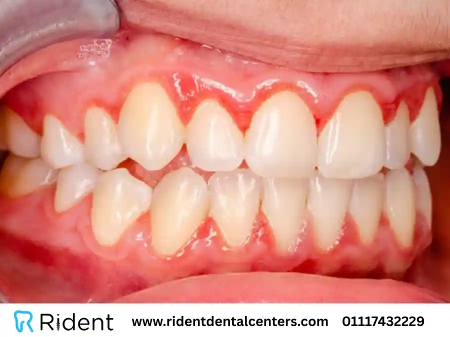 أدوية علاج التهاب اللثة والأسنان